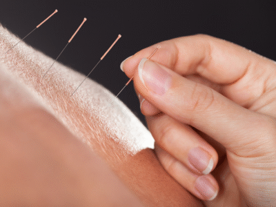 Akupunktur